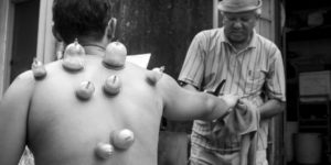 an asian man receiving cupping therapy