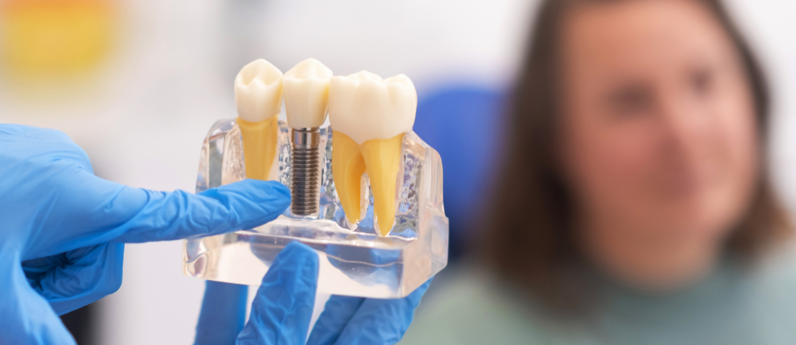 Dentist showing the placement of a dental implant on a plastic tooth model.